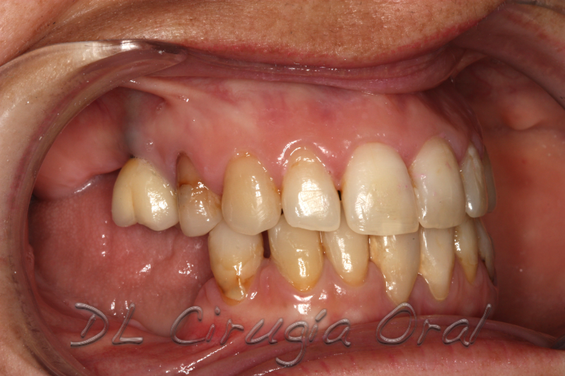 atrophic posterior mandible reconstruction