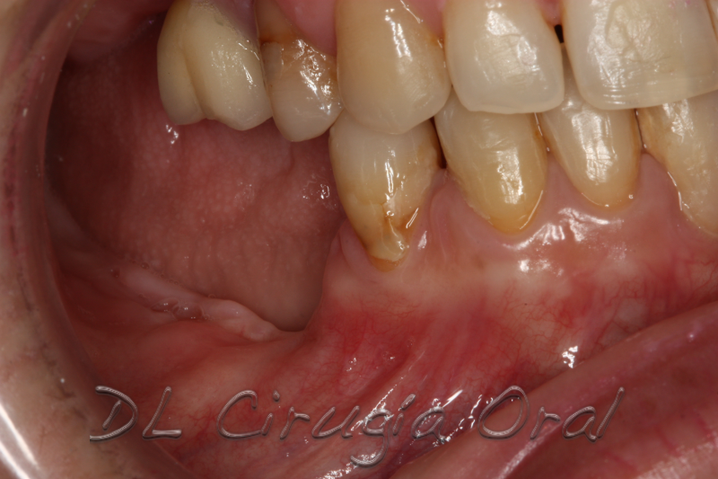 atrophic posterior mandible reconstruction