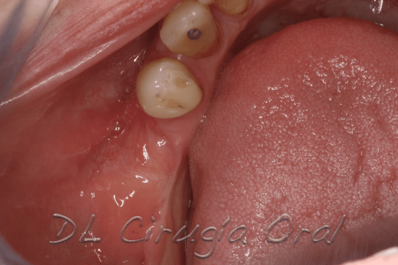 atrophic posterior mandible reconstruction