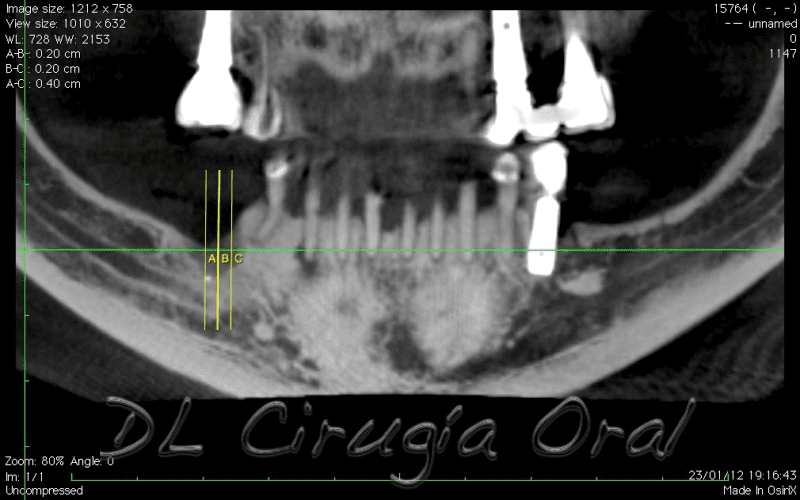 atrophic posterior mandible reconstruction