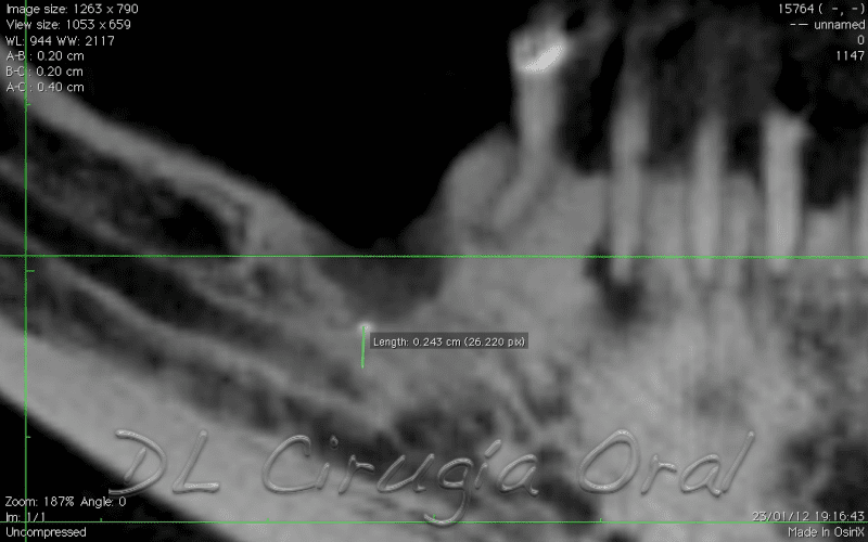 Atrophic Posterior Mandible Reconstruction Using 3D Tunnel Technique