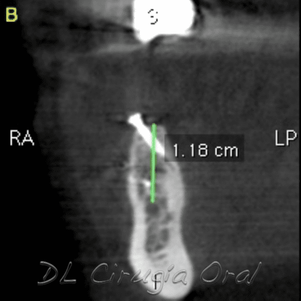 atrophic posterior mandible reconstruction