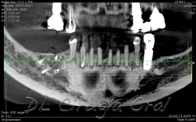 atrophic posterior mandible reconstruction