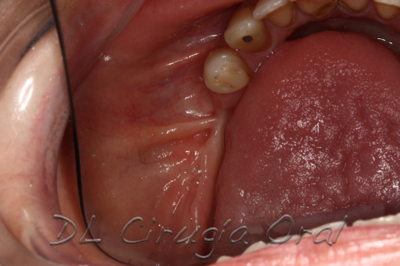 atrophic posterior mandible reconstruction