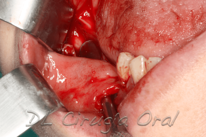 atrophic posterior mandible reconstruction