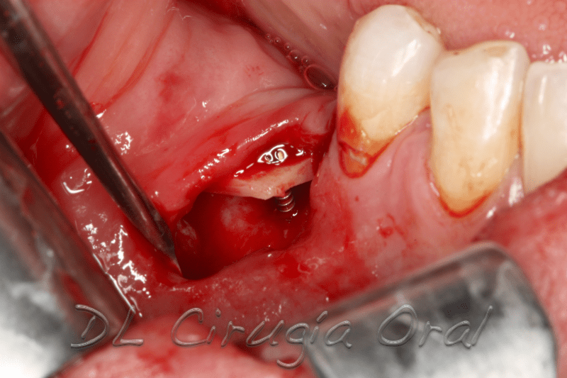 atrophic posterior mandible reconstruction