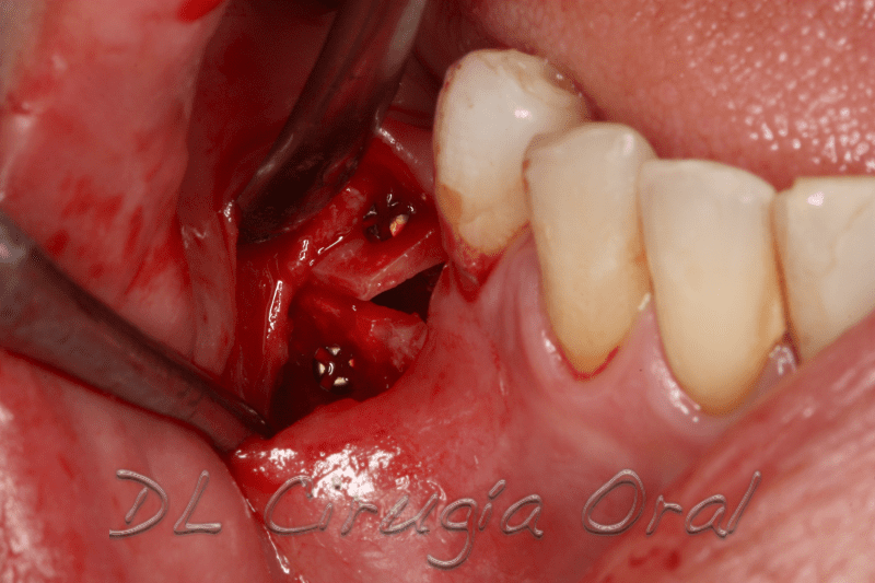 atrophic posterior mandible reconstruction