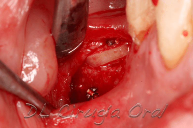 atrophic posterior mandible reconstruction