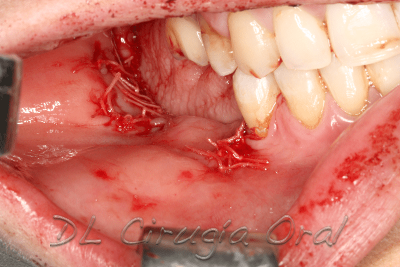 atrophic posterior mandible reconstruction