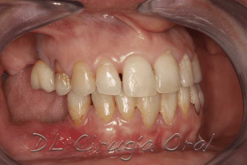atrophic posterior mandible reconstruction
