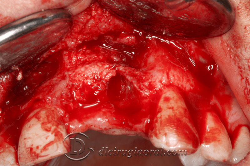 reconstruction after failed implant