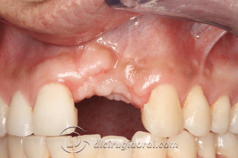 reconstruction after failed implant
