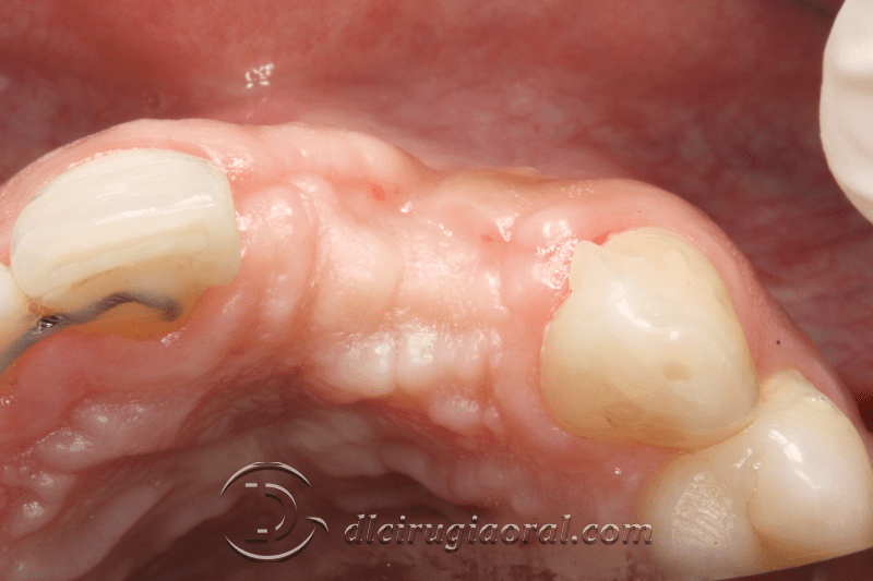 reconstruction after failed implant