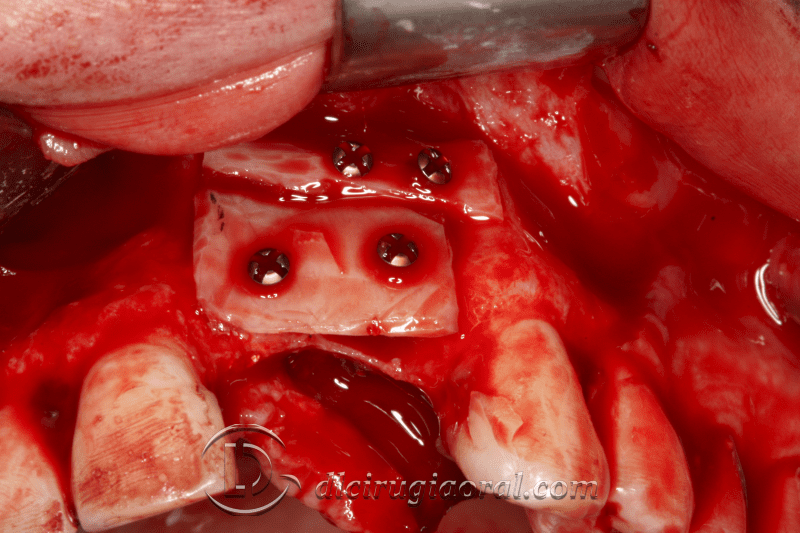 reconstruction after failed implant