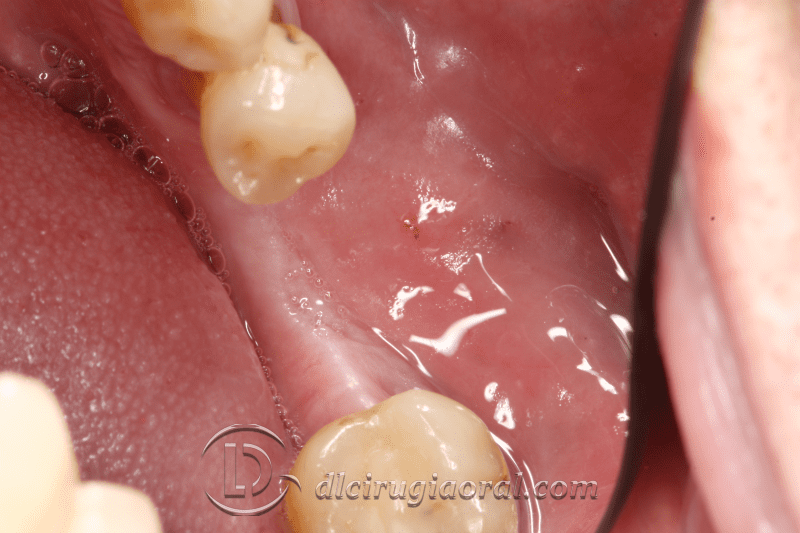 Kazanjian vestibuloplasty
