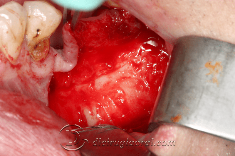 Kazanjian vestibuloplasty