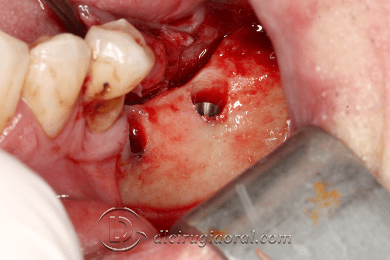 Kazanjian vestibuloplasty