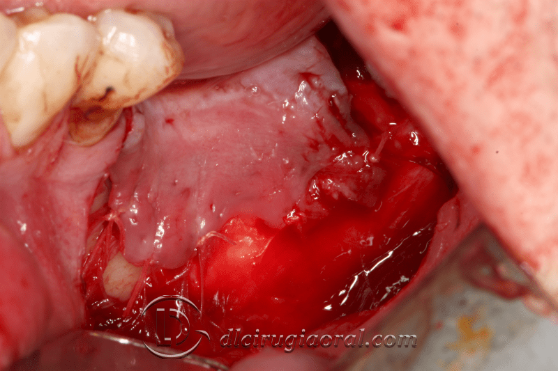 Kazanjian vestibuloplasty