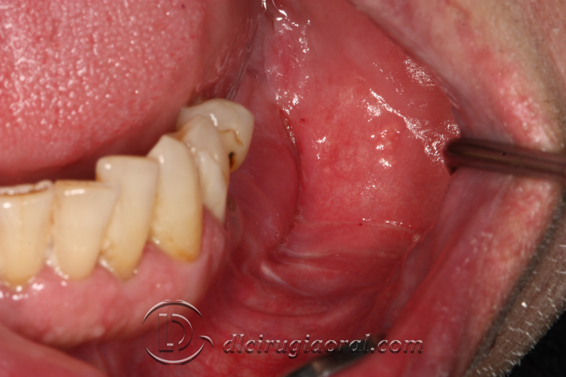 Kazanjian Vestibuloplasty to Improve Soft Tissue Conditions
