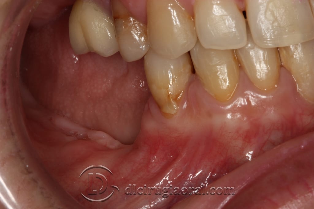 implant surgery in the mandible