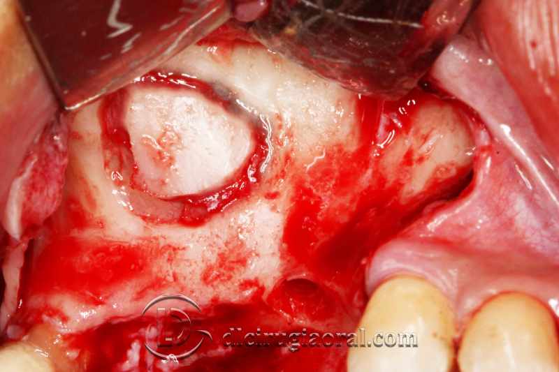 explantation and implantation with sinus lift