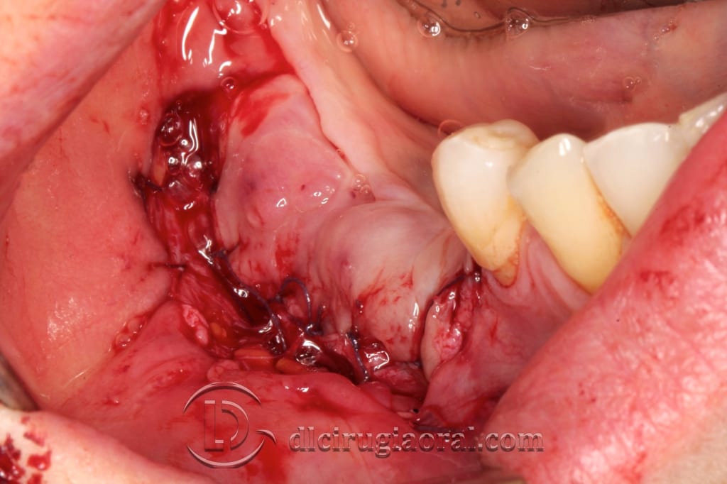 implant surgery in the mandible