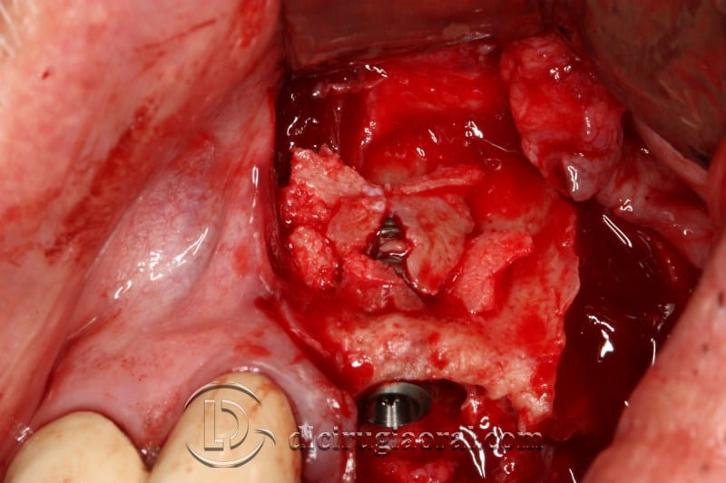 block regeneration and sinus lift