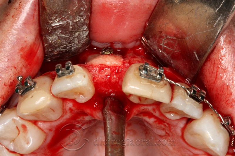 atrophy in central incisor
