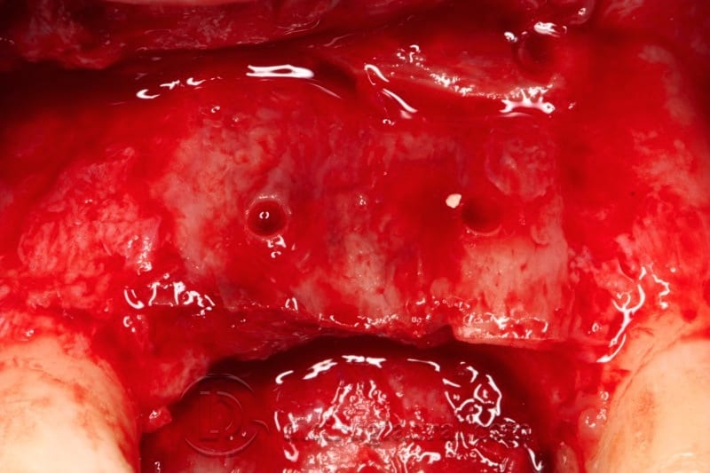 Bleeding bone