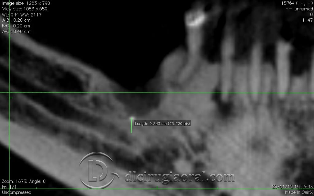 implant surgery in the mandible