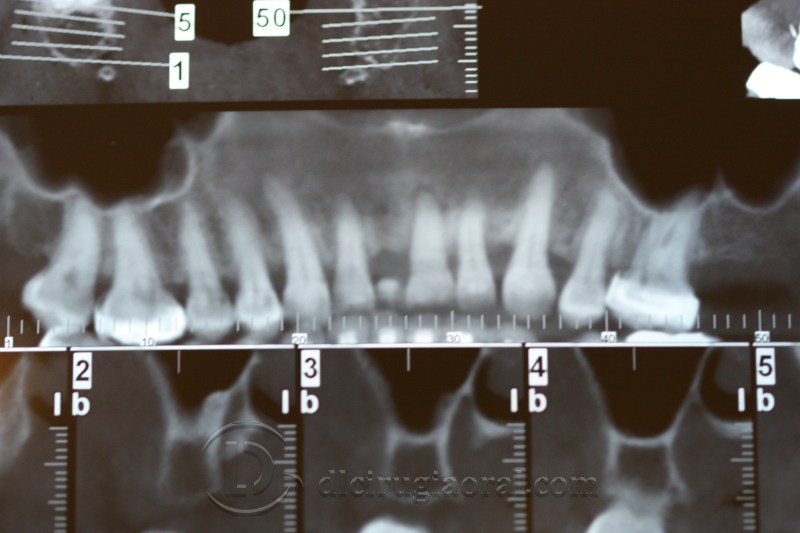atrophy in central incisor