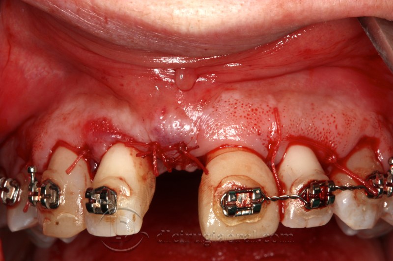 atrophy in central incisor