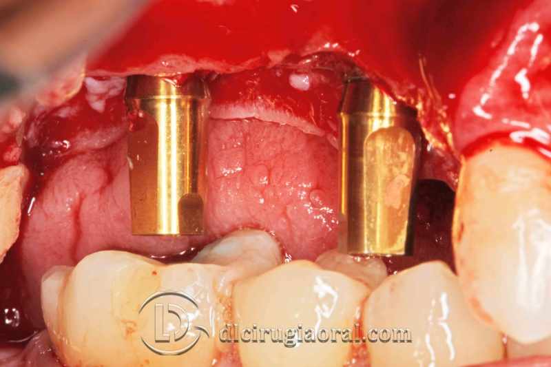 explantation and implantation with sinus lift