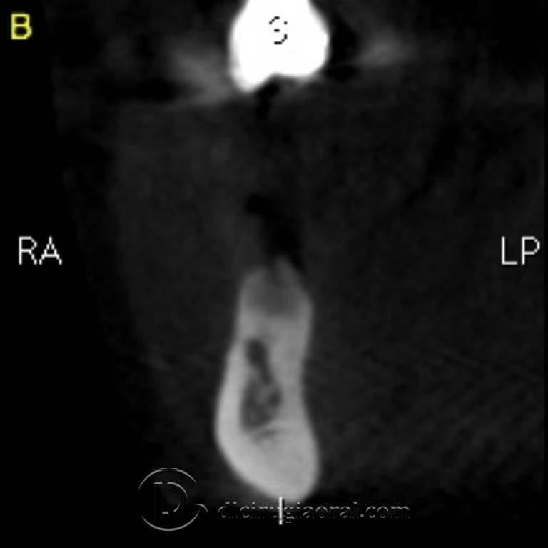 implant surgery in the mandible