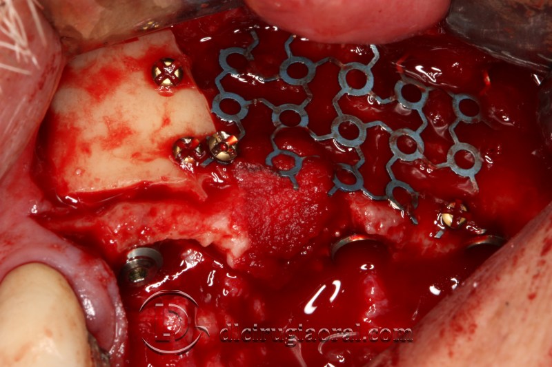 Block Regeneration and Sinus Lift Combined in One Case