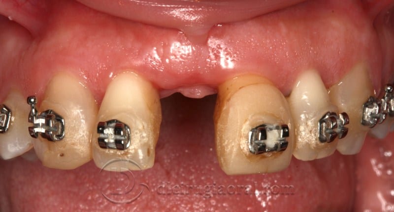 atrophy in central incisor