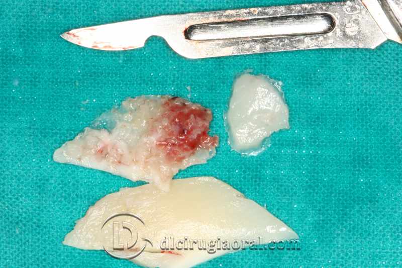 explantation and implantation with sinus lift