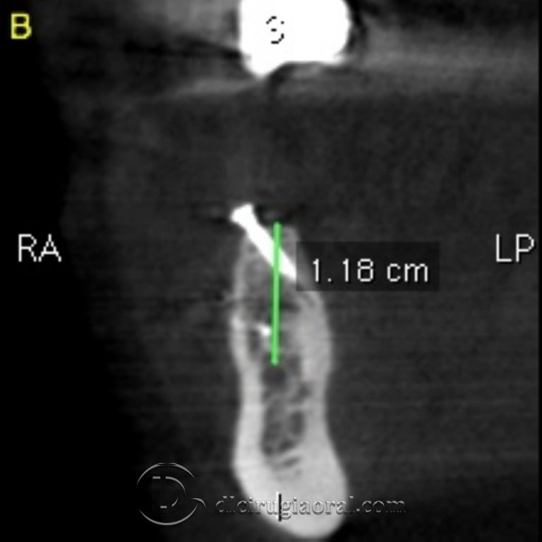 implant surgery in the mandible