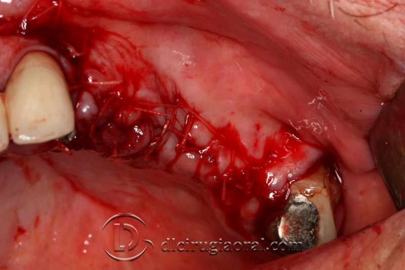 block regeneration and sinus lift