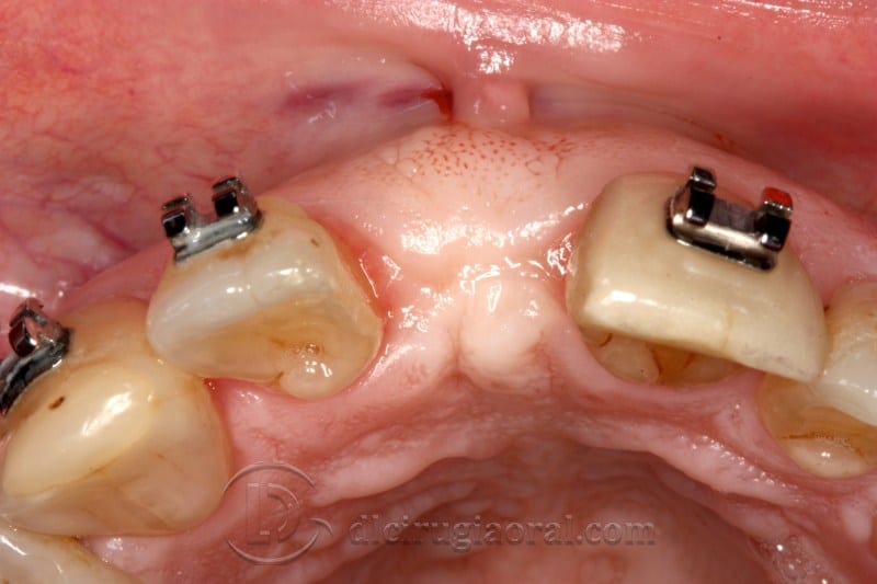 atrophy in central incisor