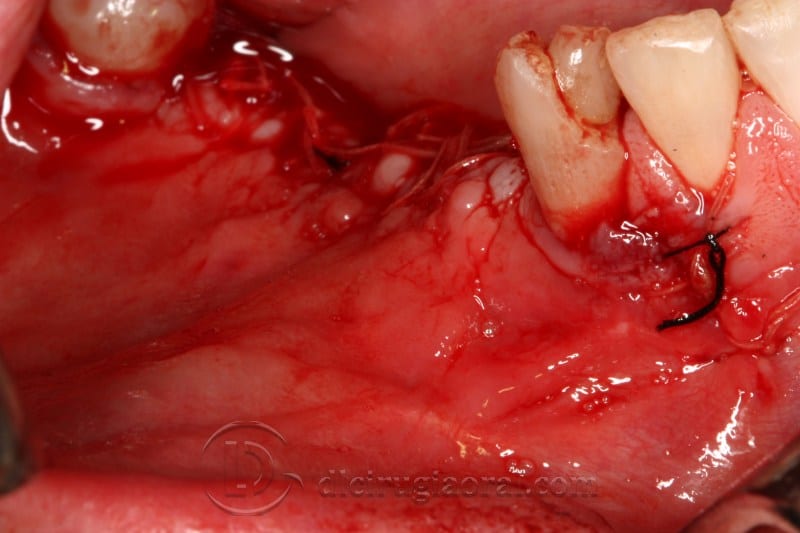 mandibular reconstruction