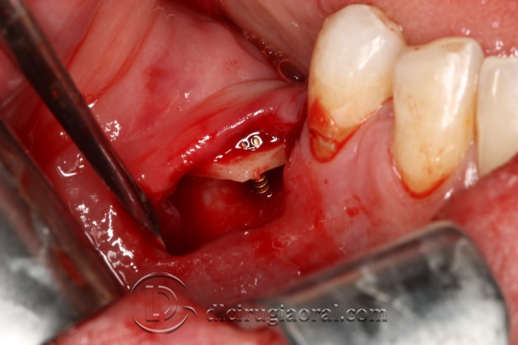 implant surgery in the mandible