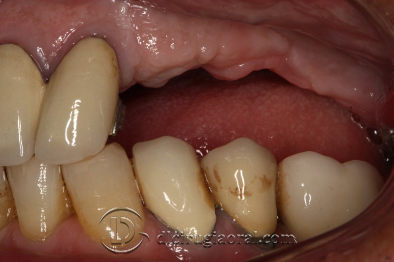 block regeneration and sinus lift