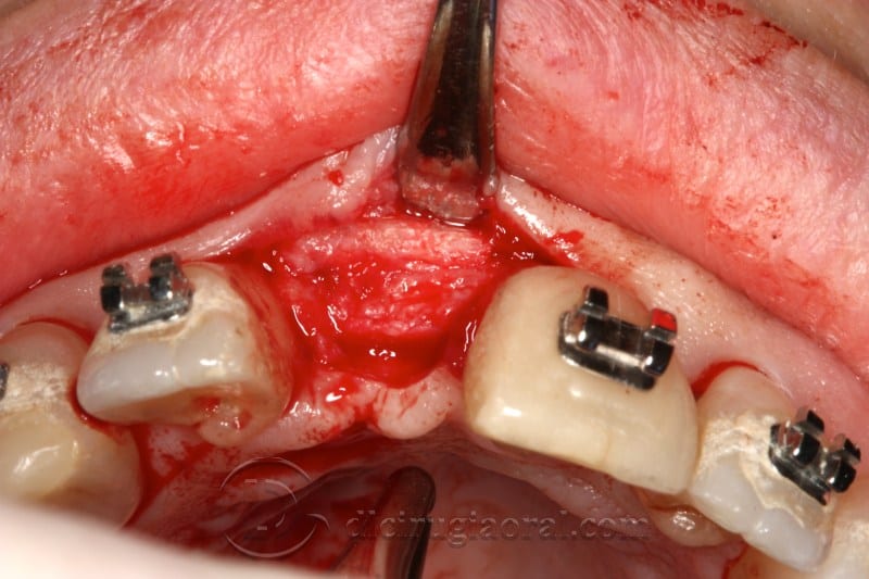 atrophy in central incisor