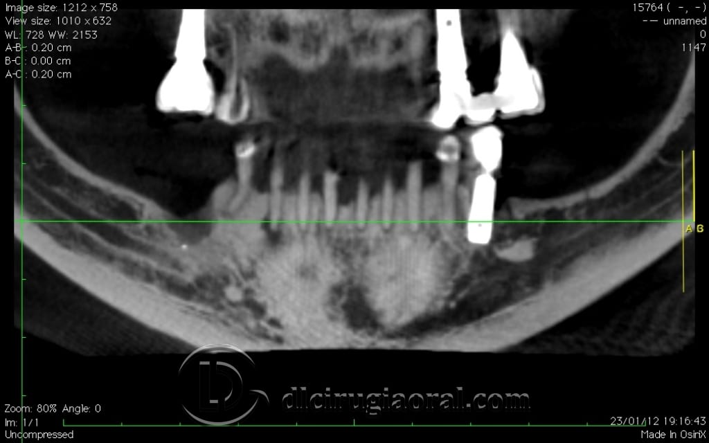 implant surgery in the mandible