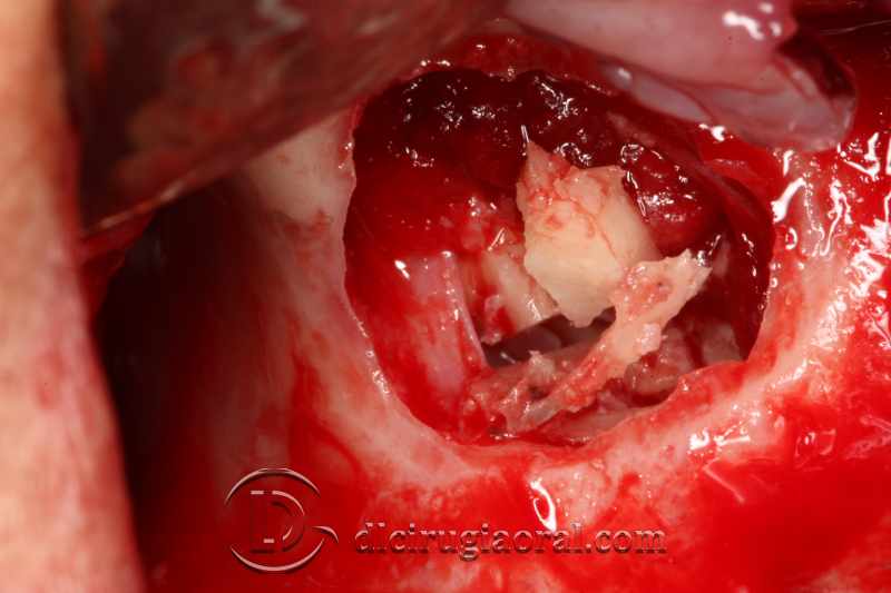 explantation and implantation with sinus lift