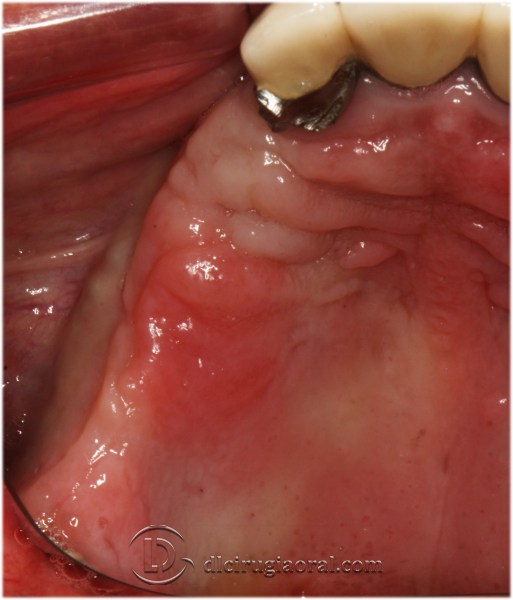 block regeneration and sinus lift