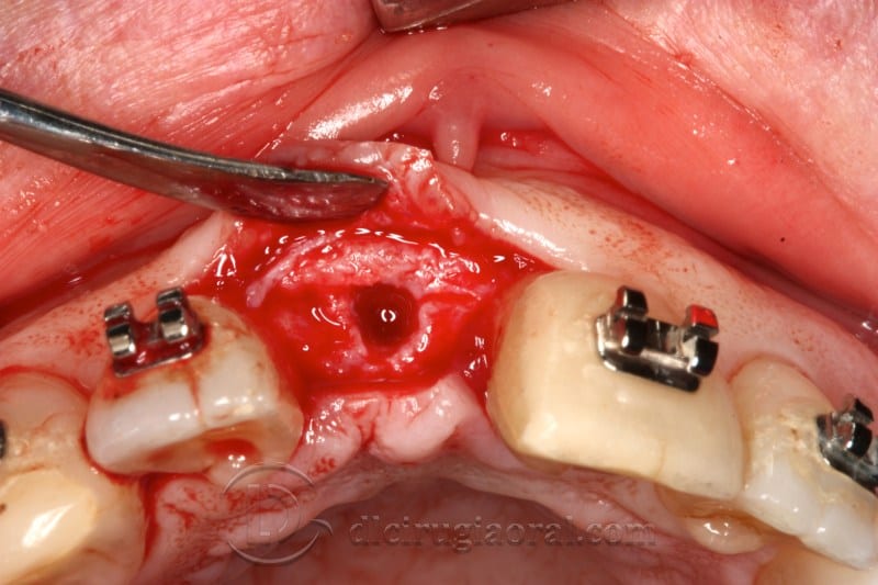 atrophy in central incisor