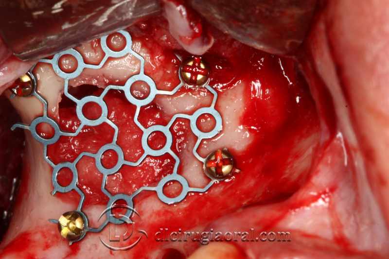 explantation and implantation with sinus lift