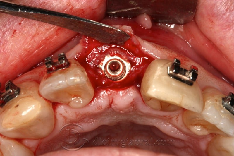 atrophy in central incisor